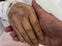 20250903After surgery